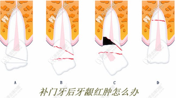補(bǔ)牙后牙齦紅腫的原因