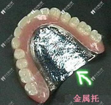 金屬活動(dòng)義齒