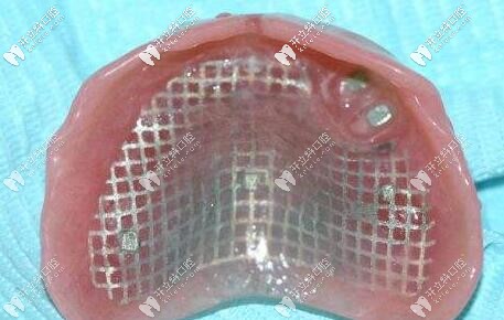 膠托鑄網(wǎng)活動(dòng)義齒