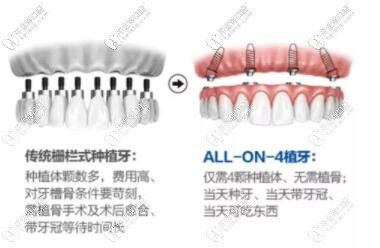 All-on-4半口種植