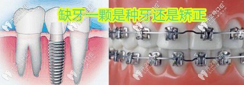 缺牙是種植牙好還是正畸好