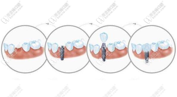 上海連鎖口腔復(fù)工了~韓國neo種植體包干價格很實在！