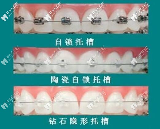 托槽種類