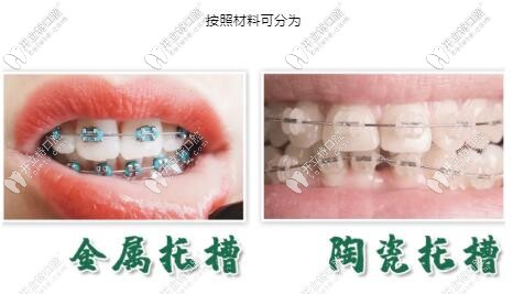 托槽材料