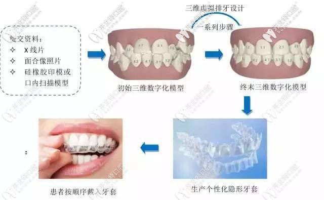 隱形牙套矯正的流程