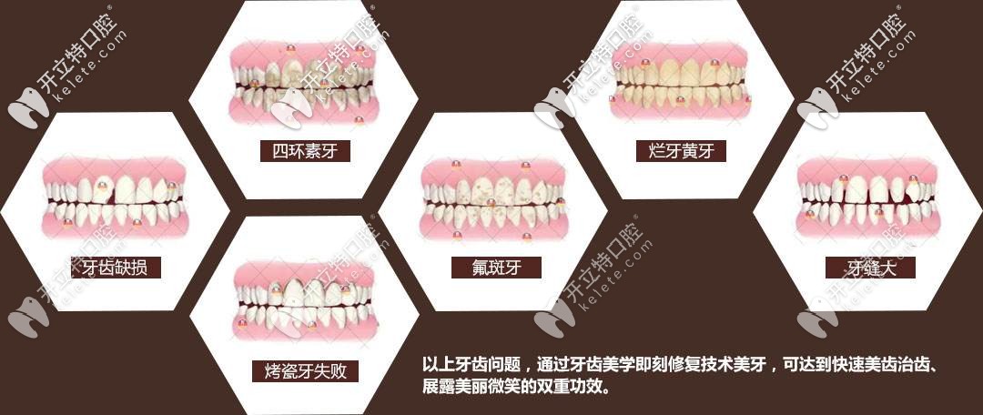 適合牙齒修復(fù)的牙齒情況