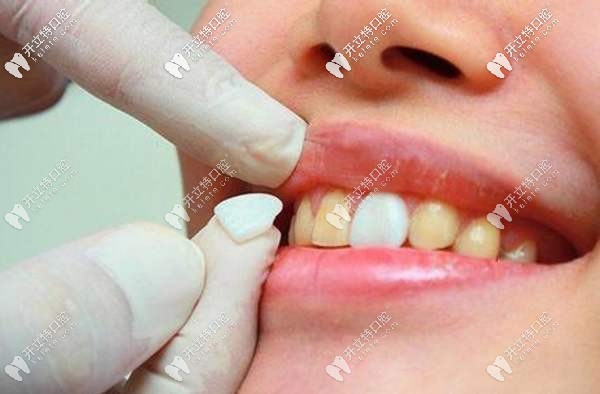 牙齒貼面修復(fù)