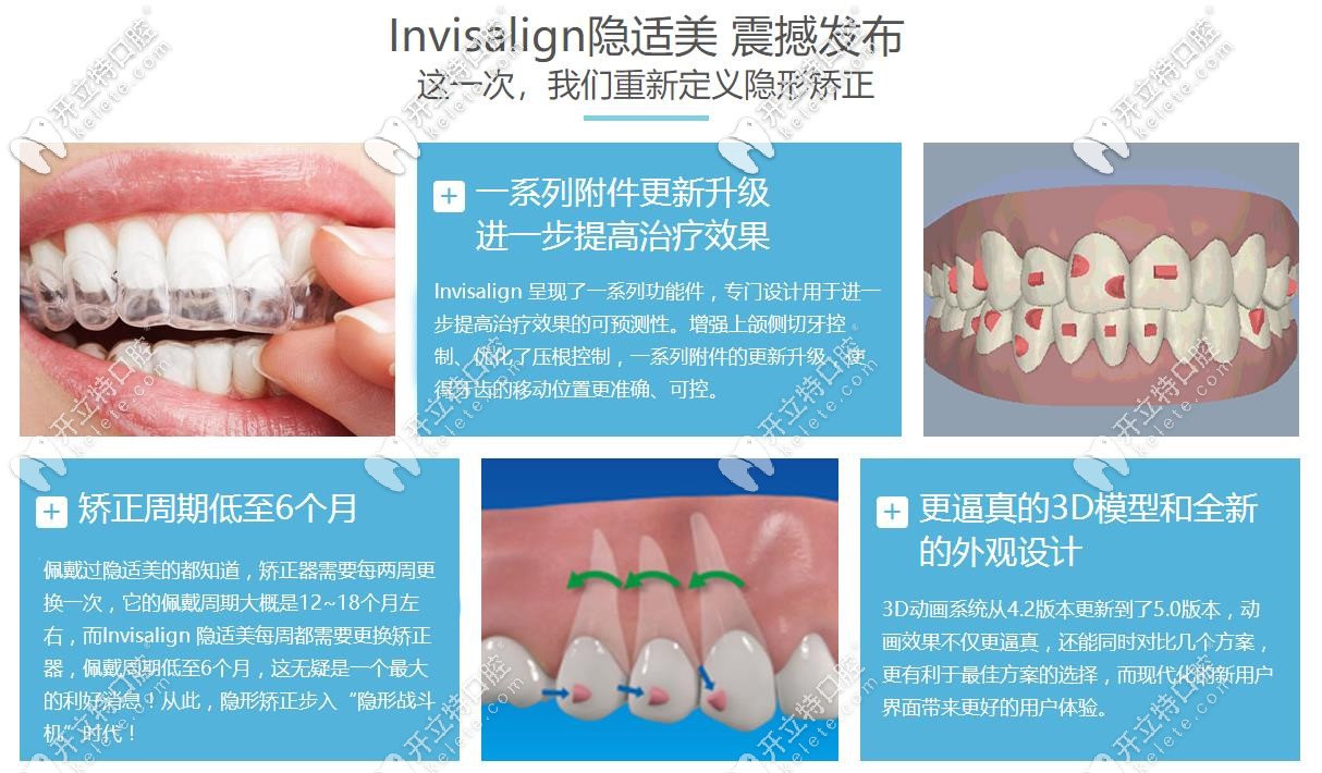 隱適美隱形矯正