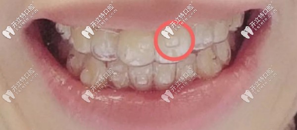 隱形牙套的附件就是我圈住的地方