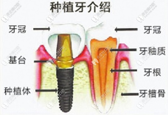 中山香山口腔醫(yī)院復(fù)活節(jié)種牙活動(dòng)