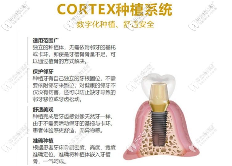 cortex種植體優(yōu)勢