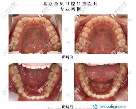 北京圣貝齒科呂杰隱形正畸案例前后對(duì)比