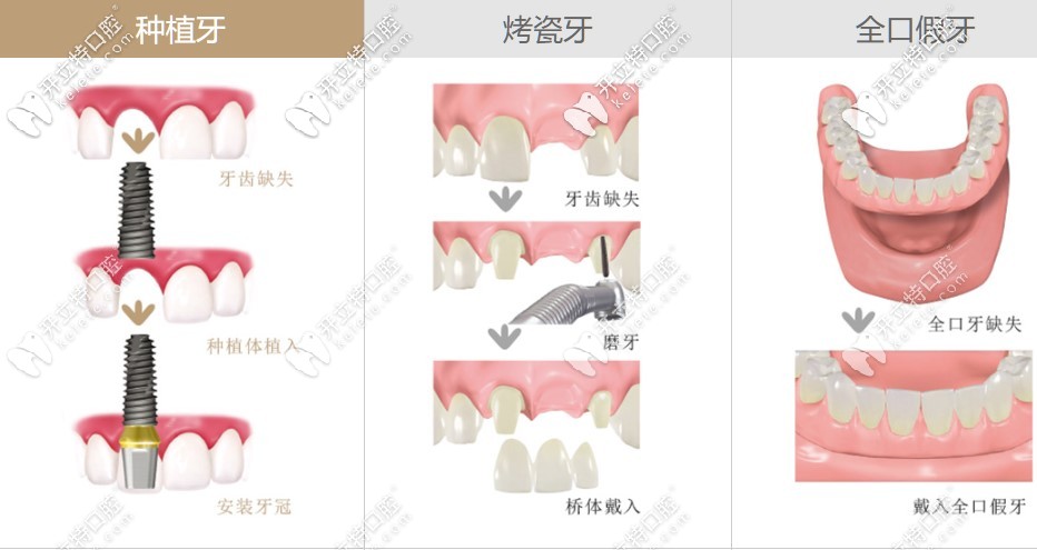 種植牙和活動假牙從價格及壽命來進行對比