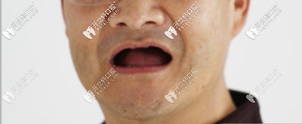 5年前全口無牙的我很顯老