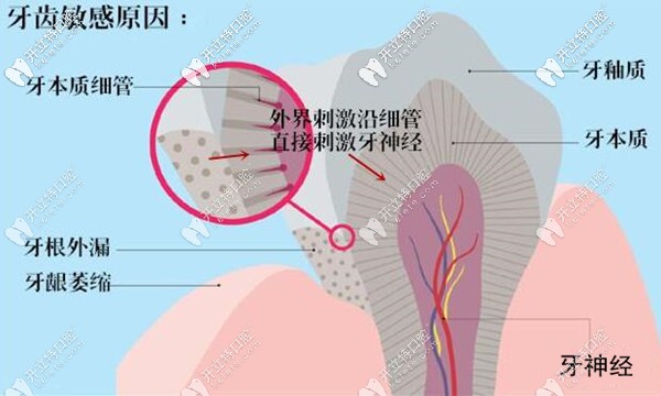 牙齒敏感的原因