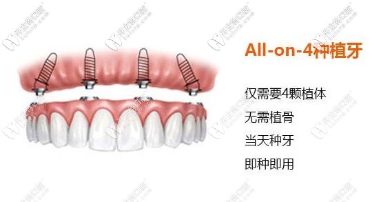 allon4種植技術只需4顆種植體