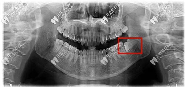 低位水平阻生齒圖片