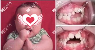 六歲孩子門牙縫隙大、扭曲適合做mrc早期矯正嗎？