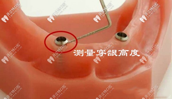 Locator種植覆蓋義齒的流程