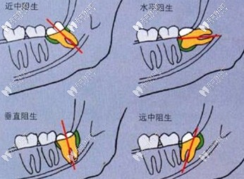 阻生智齒會(huì)引發(fā)的危害