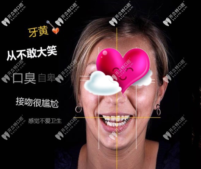 做牙齒貼面前