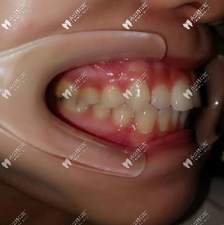  曬戴隱適美牙套內(nèi)收前突牙效果圖,齙牙矯正280天下巴出來(lái)了