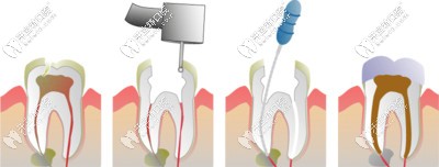 根管沖洗及消毒