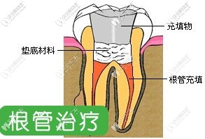 根管治療的步驟