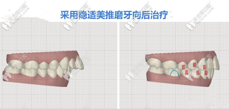 矯正齙牙隱形牙套快還是鋼絲牙套快