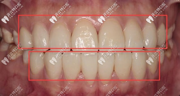 重度氟斑牙做瓷貼面修復(fù)后效果