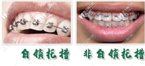 細(xì)說國產(chǎn)自鎖托槽品牌歐睛和OBrace球托的區(qū)別及價格