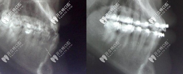 用帶狀弓矯正器矯正骨性Ⅲ類錯(cuò)合矯治前后