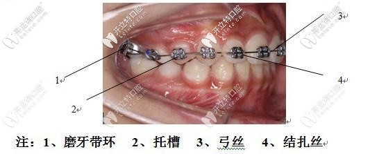 begg細絲弓矯治前牙擁擠