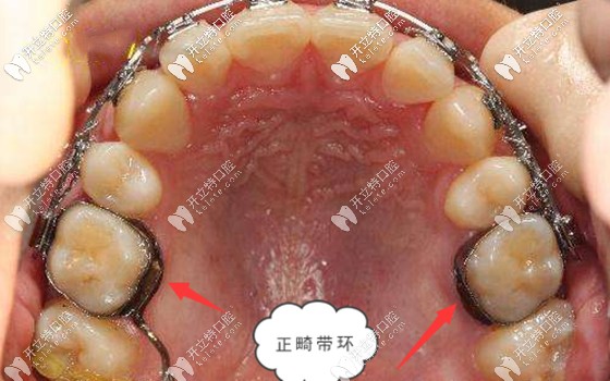 正畸帶環(huán)的優(yōu)缺點(diǎn)