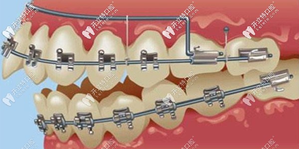 自鎖托槽矯正器