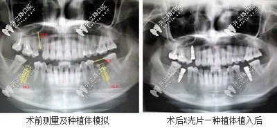 口內(nèi)模擬種植
