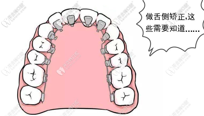 福州做舌側(cè)矯正注意事項