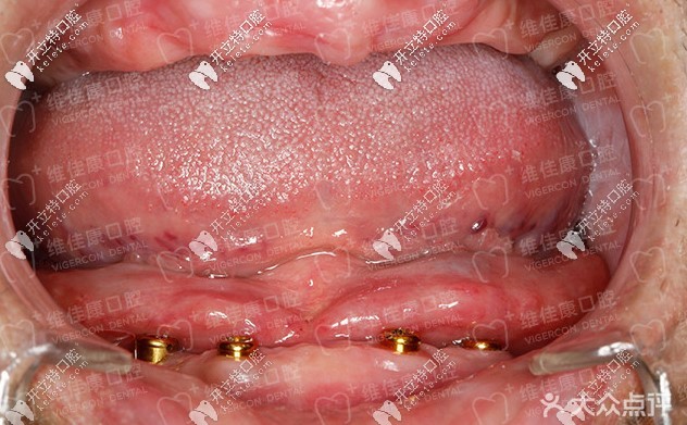 60歲王大爺做allon4全口快速種植牙花了十多萬(wàn)，兒子卻說(shuō)……