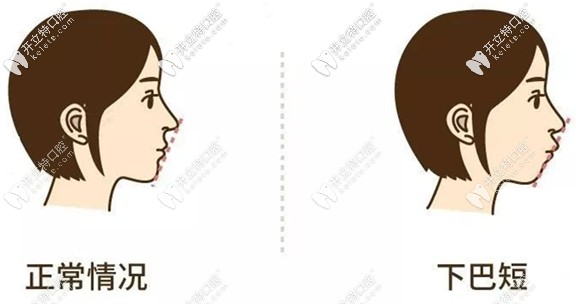 就是這“深覆蓋”引起了我凸嘴和下巴后縮的側(cè)貌