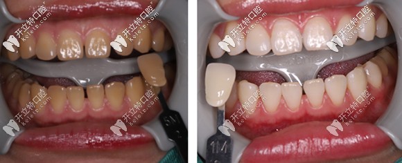 做完一個(gè)療程的冷光美白，牙齒色號(hào)由5M贈(zèng)白到1M