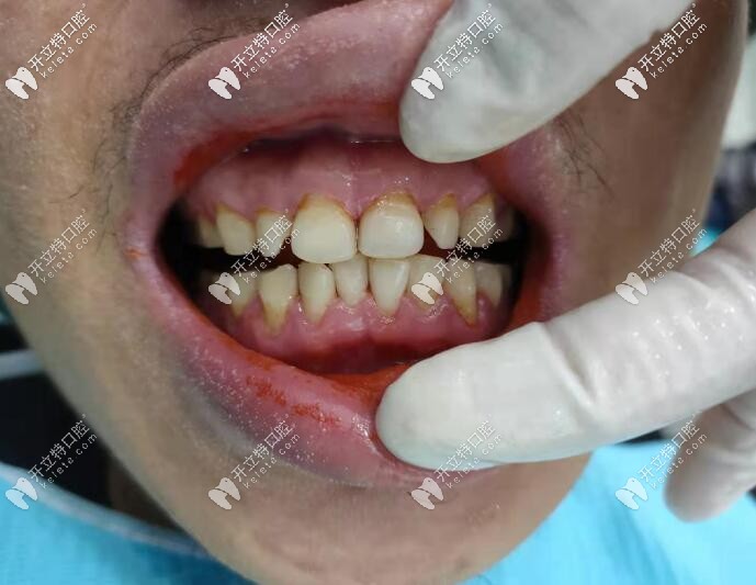 海南?？谖⑿谇粺煗n牙洗牙真人案 