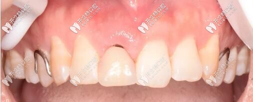 活動義齒修復(fù)門牙 