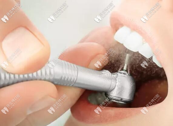 洗牙