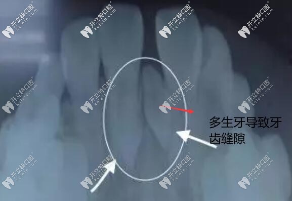 多生牙導(dǎo)致牙縫