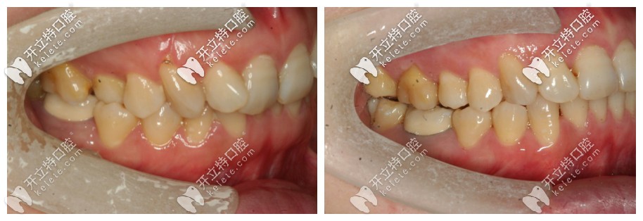 從側(cè)面照更能看出來牙齒原本的問題