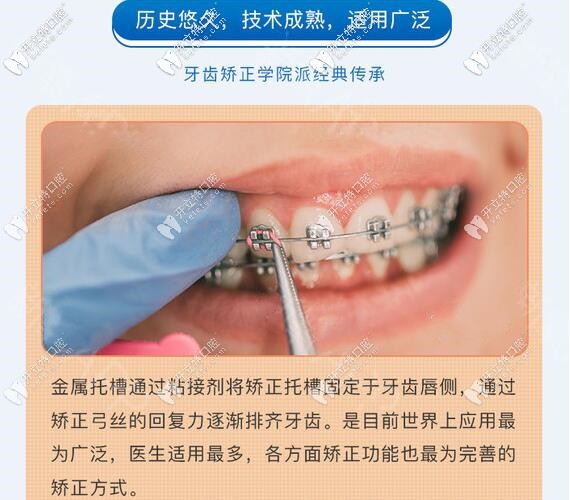 鋼絲金屬托槽牙齒矯正價格