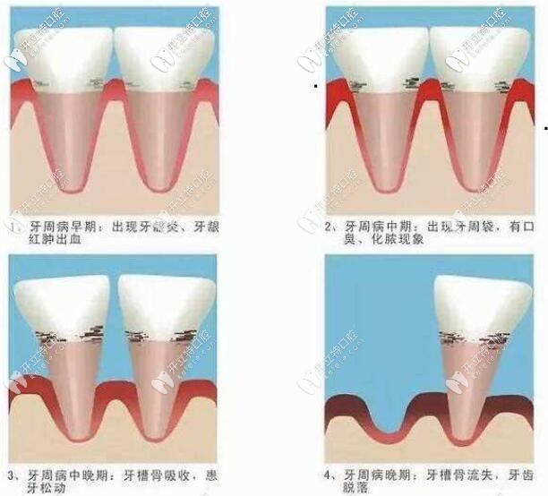 牙周炎的發(fā)展階段