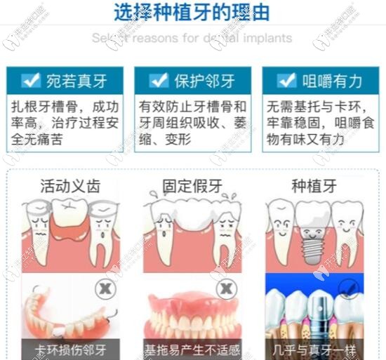 活動(dòng)義齒固定假牙和種植牙哪個(gè)好