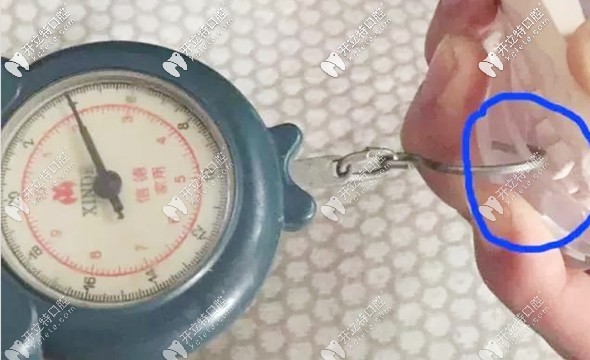 網(wǎng)購(gòu)牙套引起的危害
