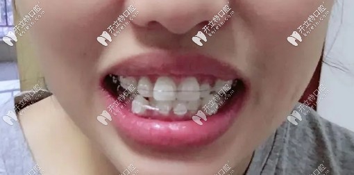 戴陶瓷自鎖托槽中期，牙齒已經(jīng)開始慢慢歸位